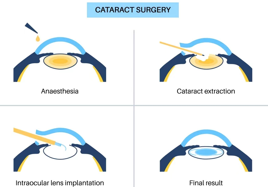 【關(guān)注眼健康】霧里看花——都是白內(nèi)障惹得禍